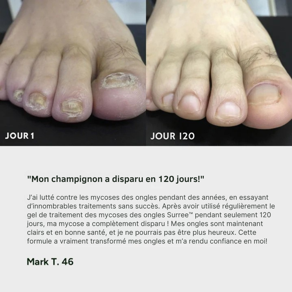 Gel de traitement des champignons des ongles Surree™