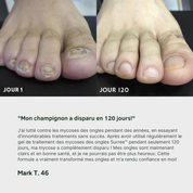 Gel de traitement des champignons des ongles Surree™